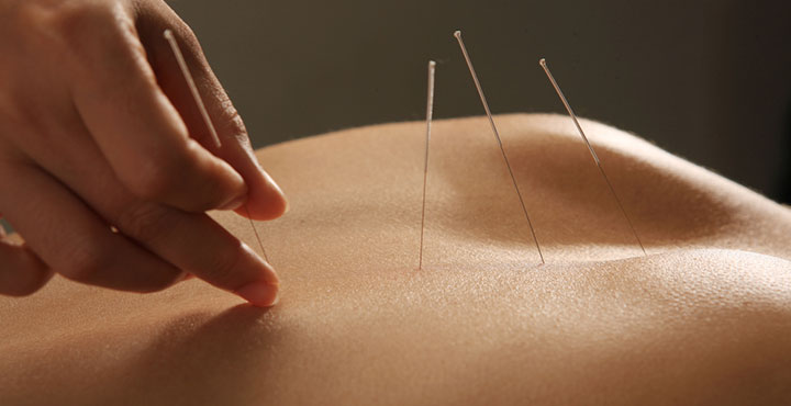 Nadelung von Akupunkturpunkten